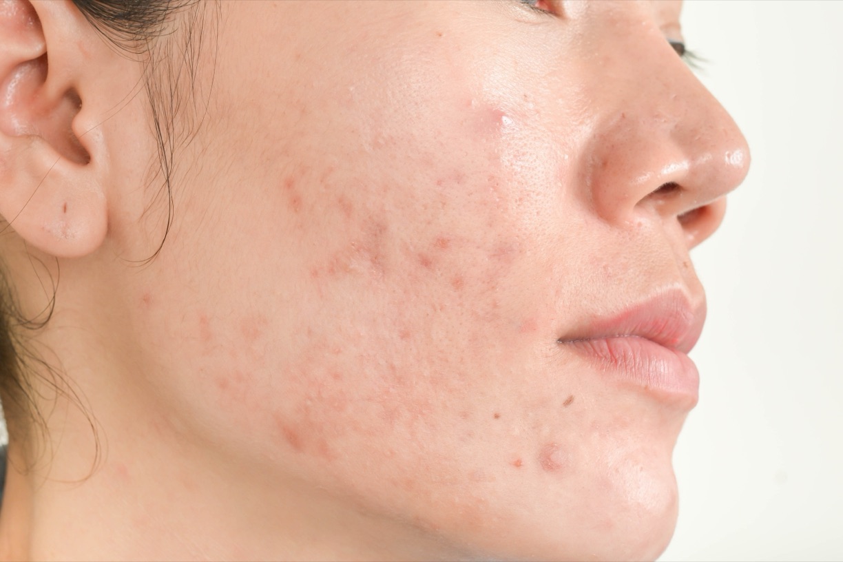 Close-up of acne-prone skin with visible congestion