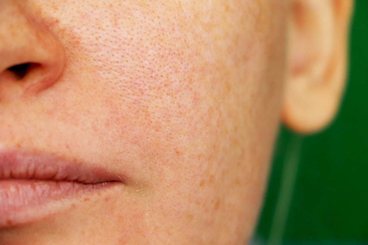 Close-up of visible pores and skin congestion