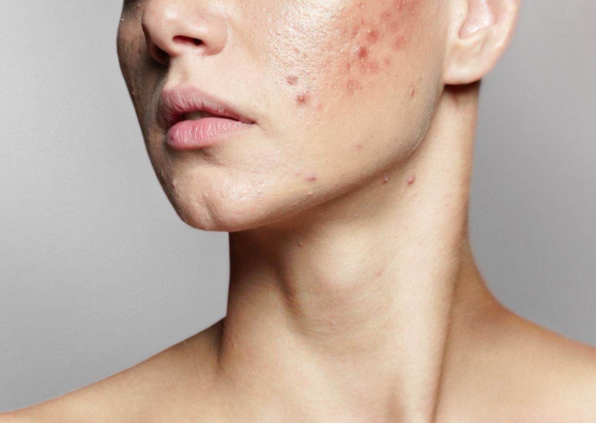 Close-up of skin texture and post-acne scarring