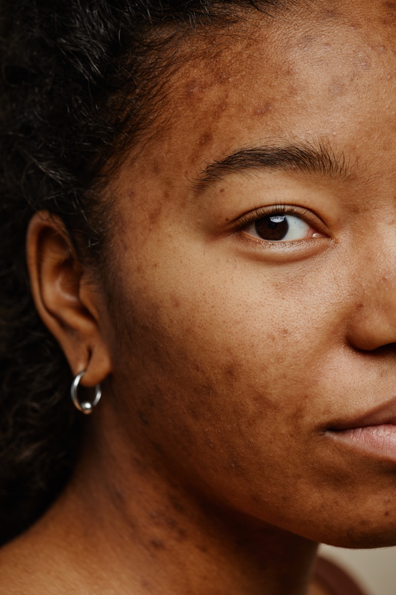 Close-up of uneven skin texture