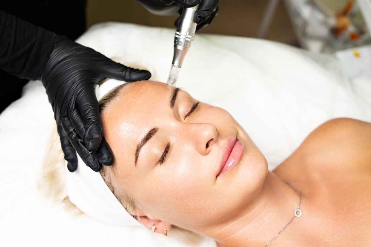 Microneedling treatment setup for skin rejuvenation
